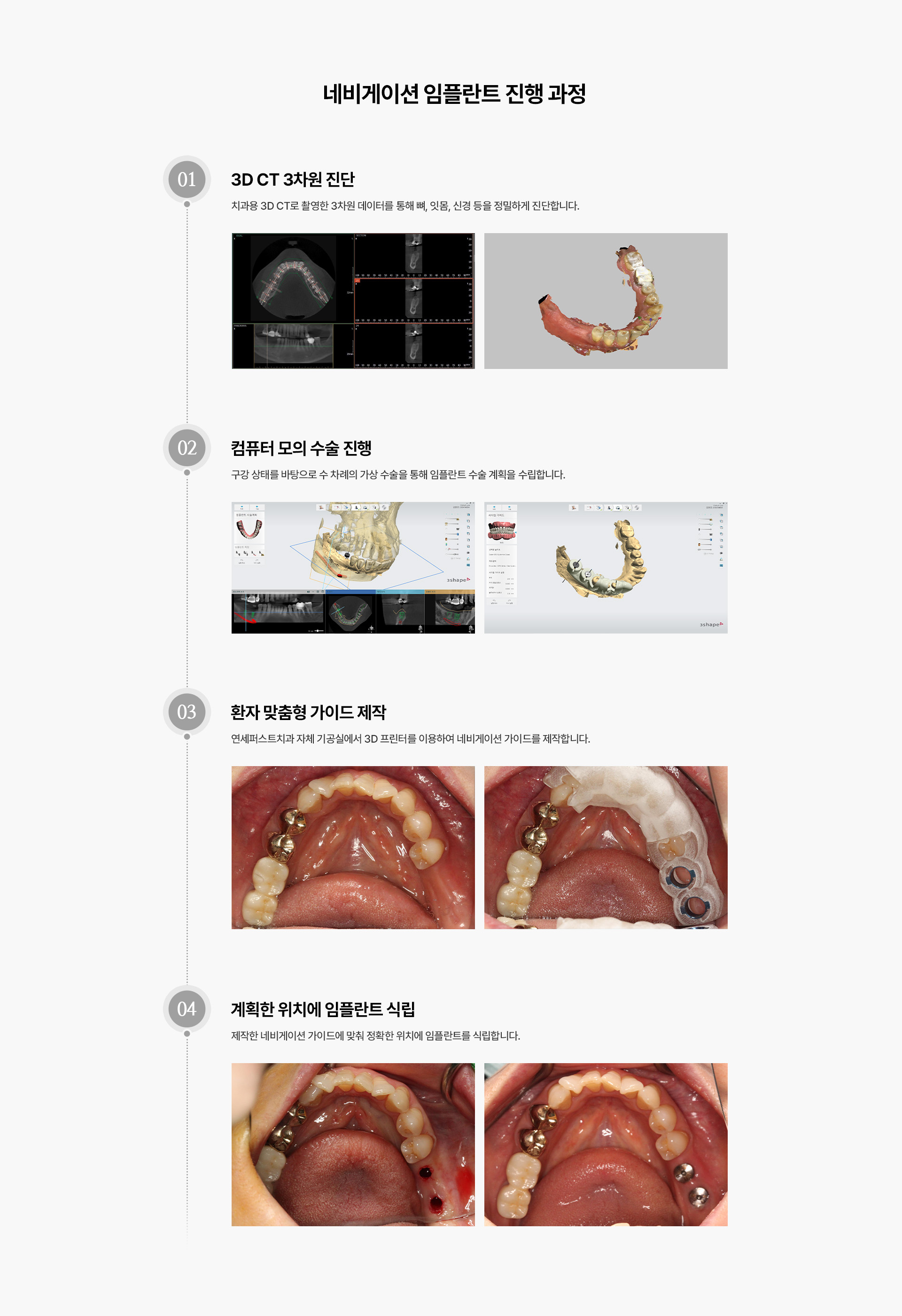 네비게이션최소절개임플란트