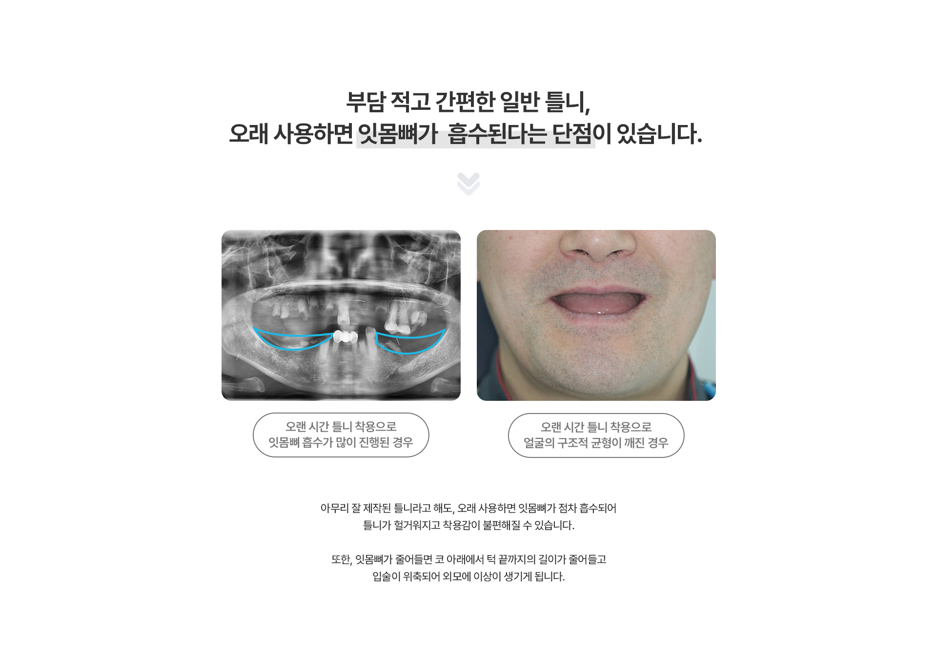 임플란트 틀니(Locator)