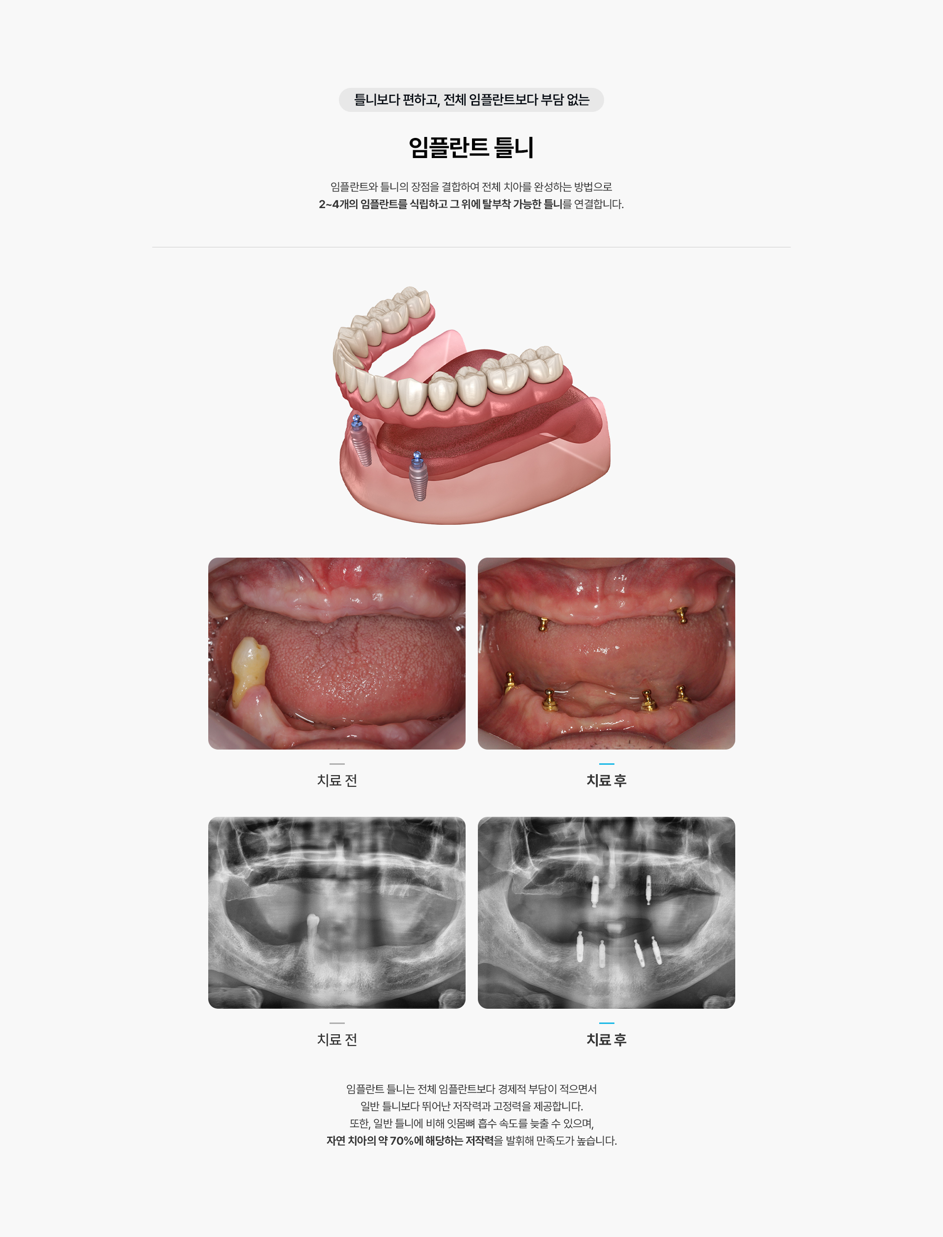 임플란트 틀니(Locator)
