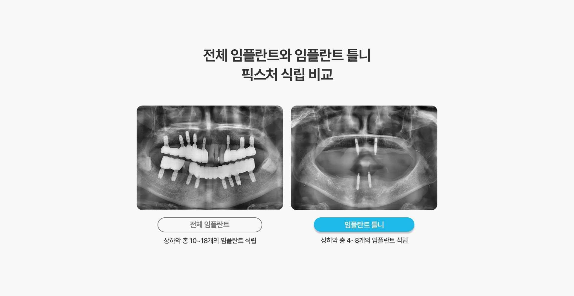 임플란트 틀니(Locator)