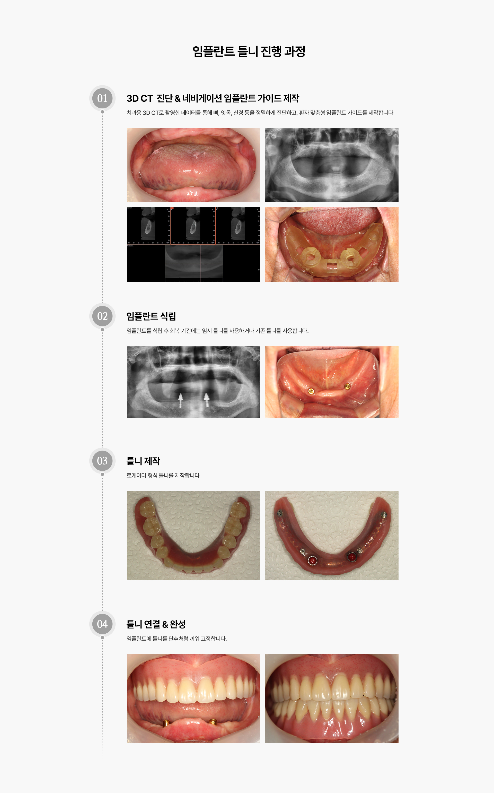 임플란트 틀니(Locator)