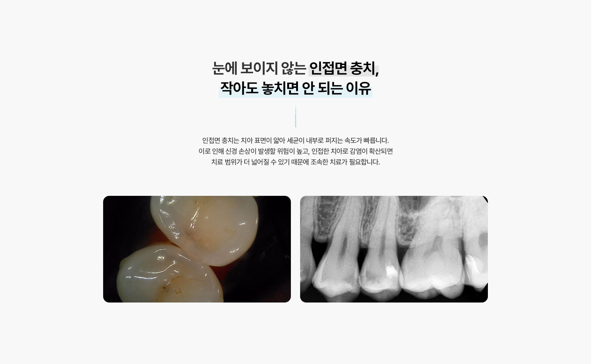 충치치료