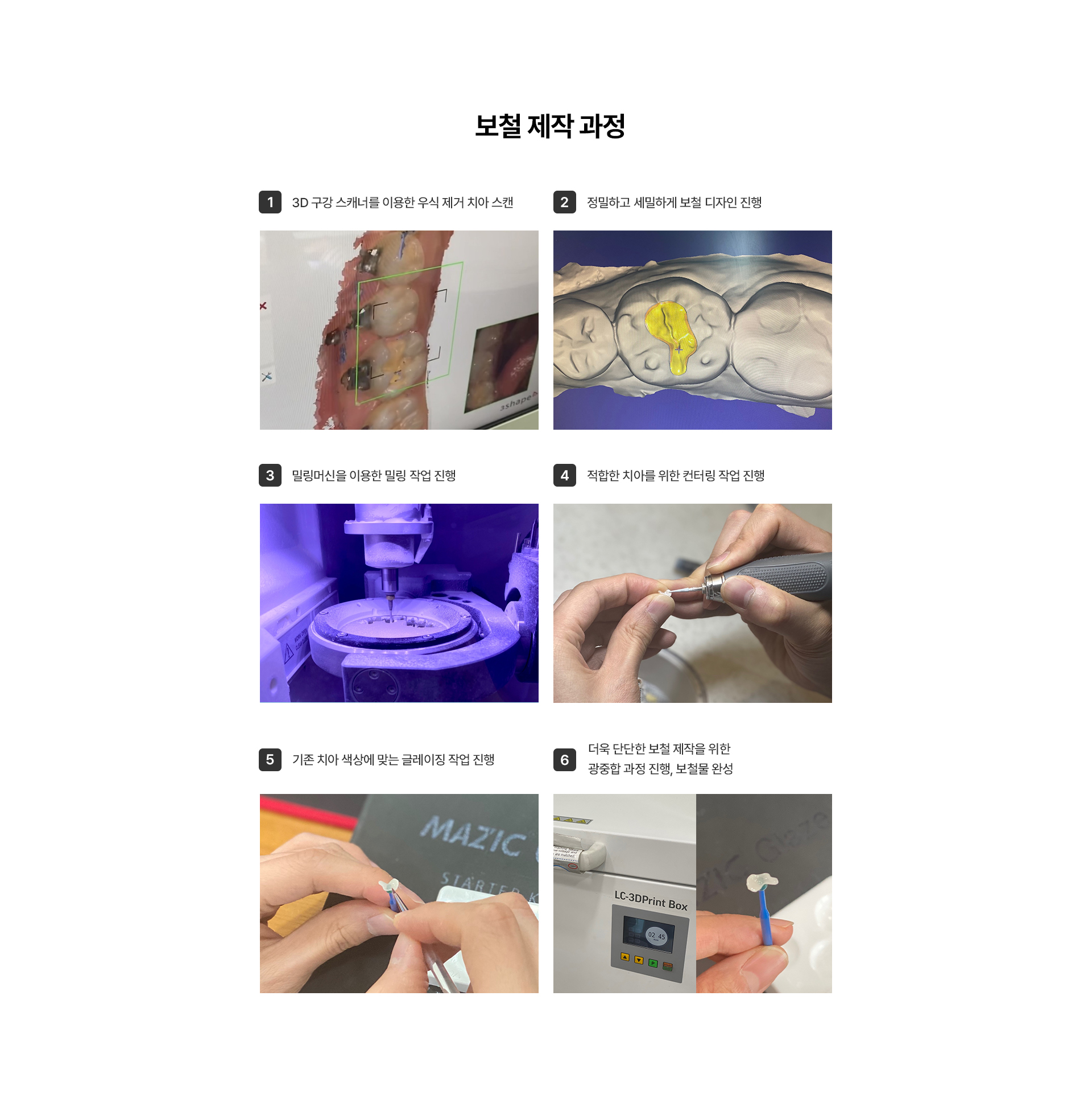 충치치료