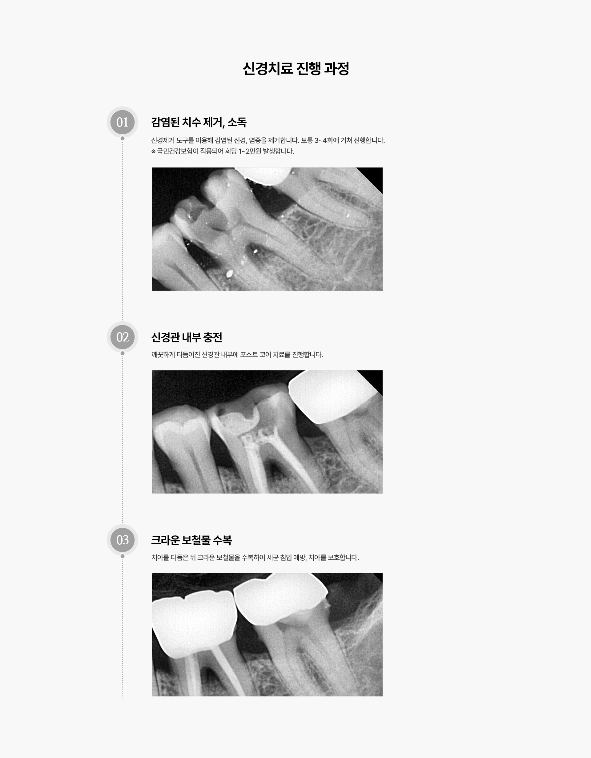 신경치료