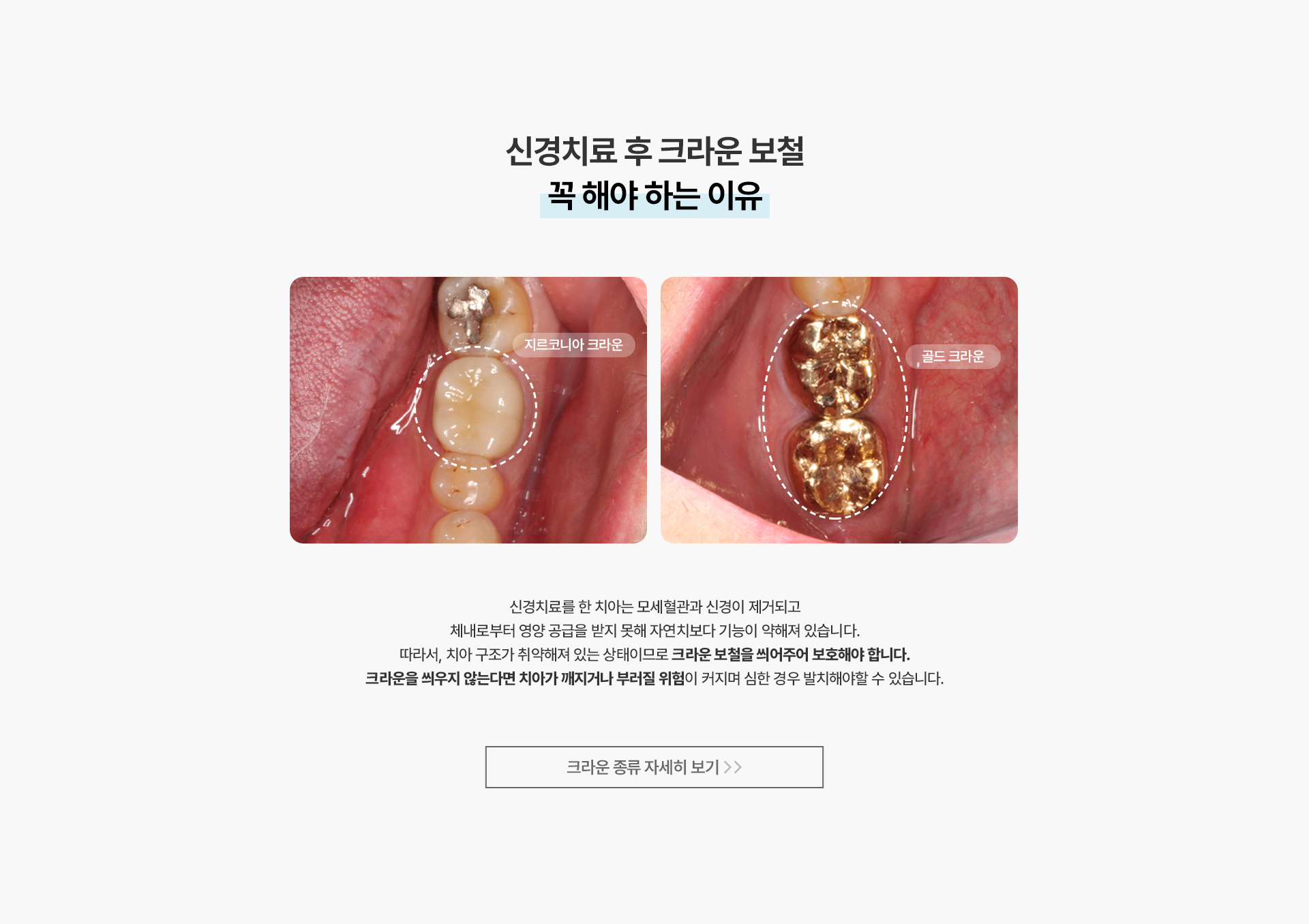 신경치료