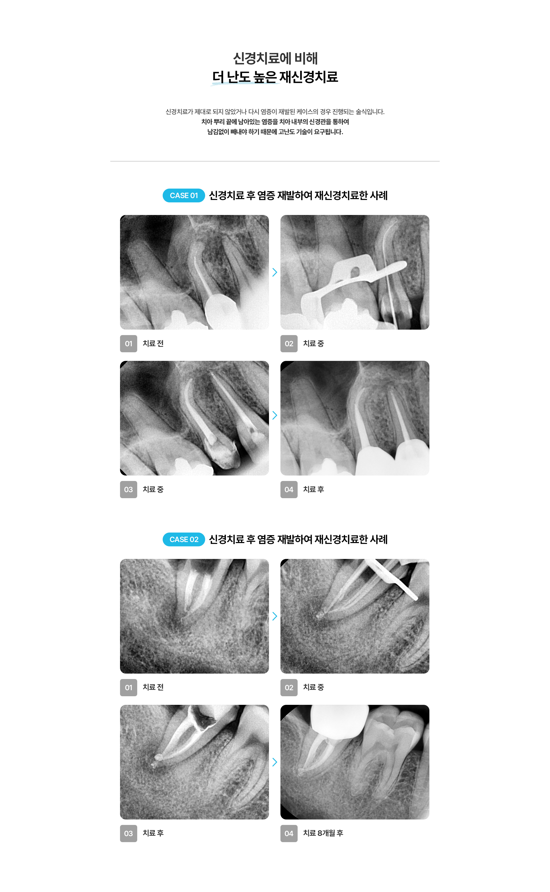신경치료