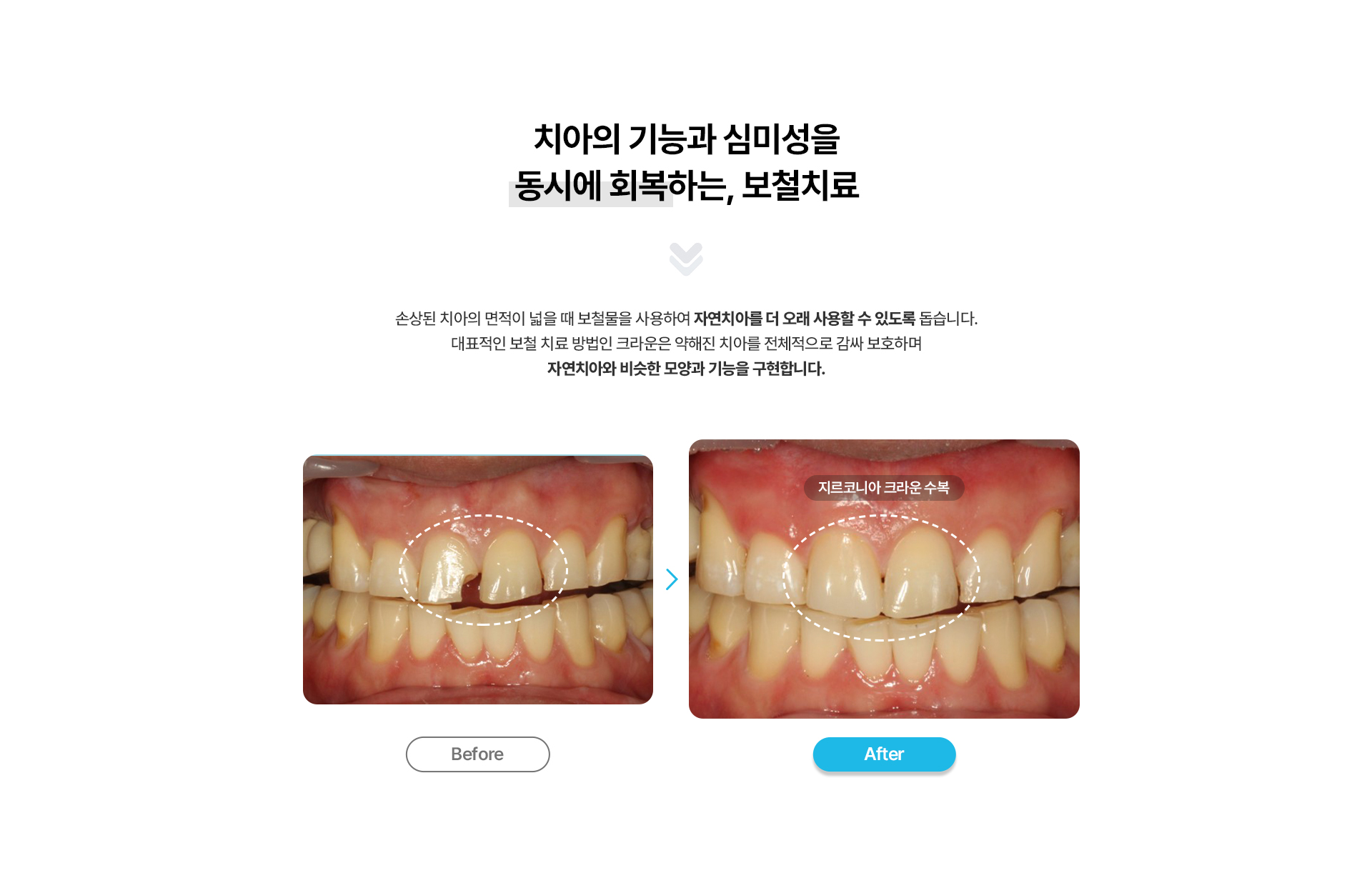 보철치료