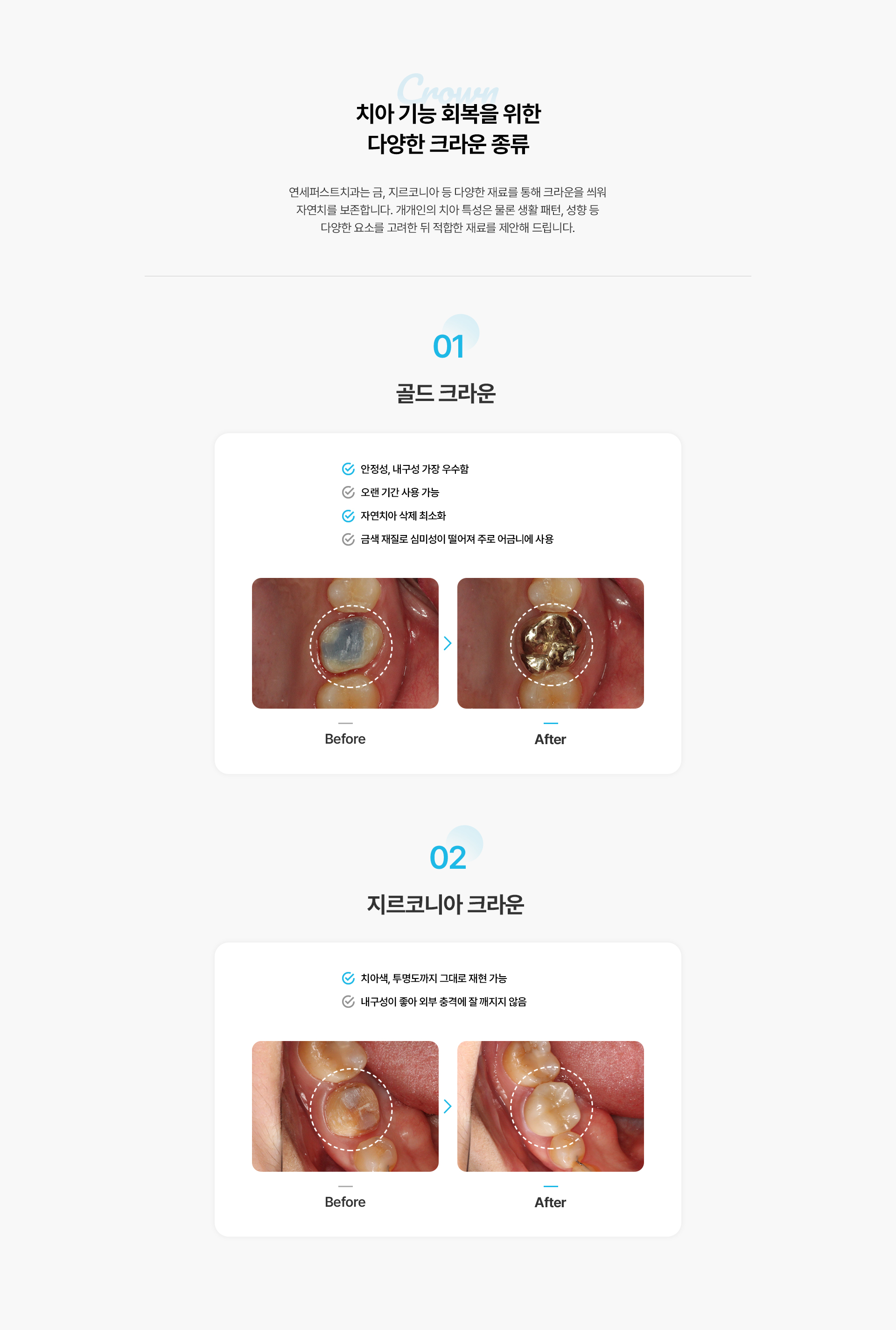 보철치료