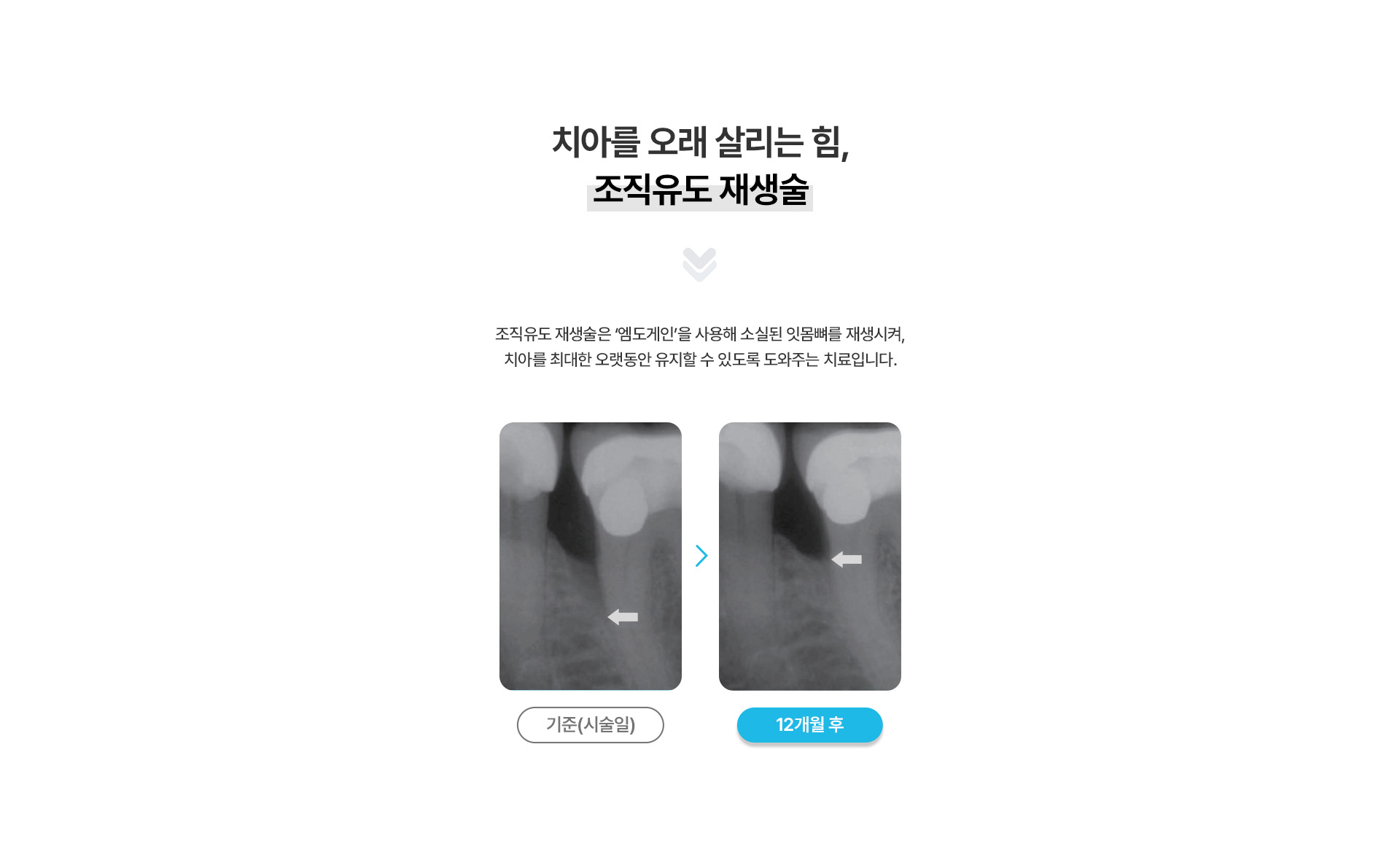 조직유도재생술