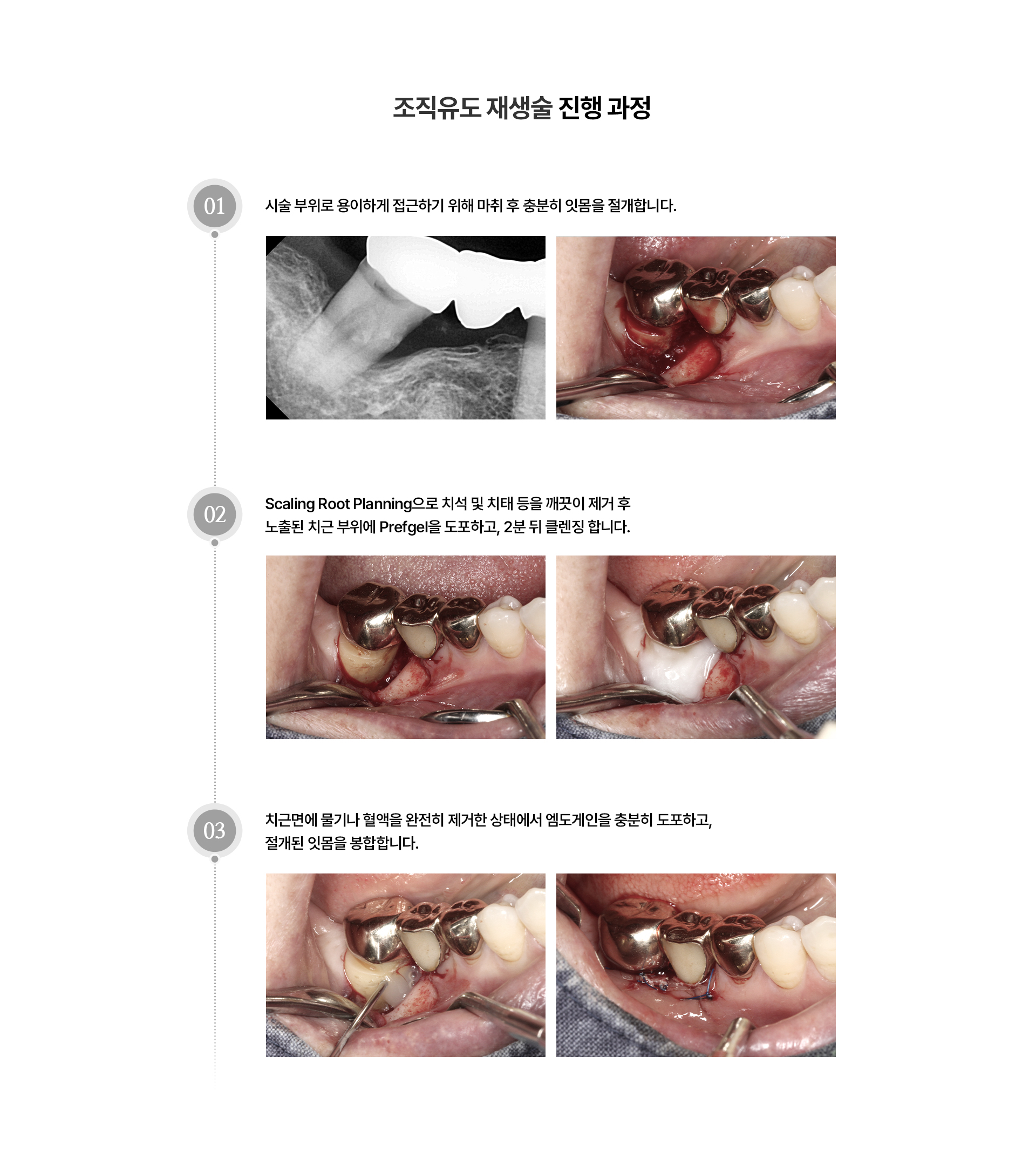 조직유도재생술