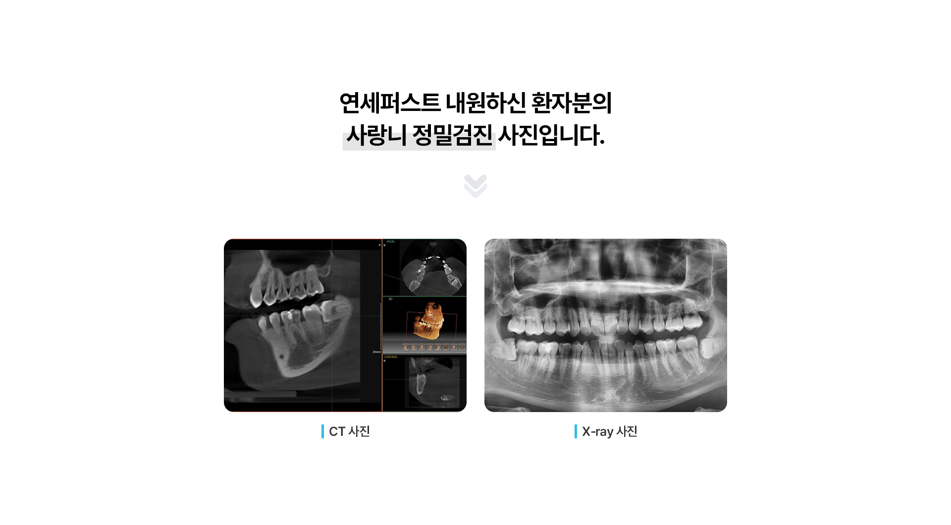 사랑니발치
