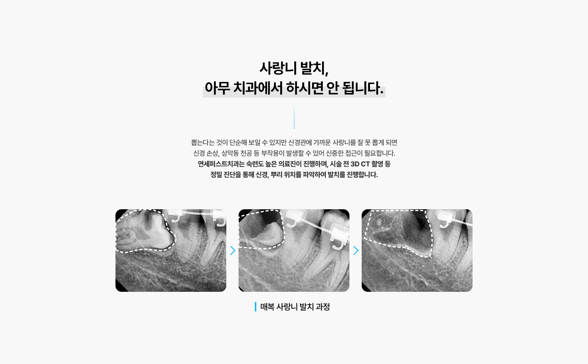 사랑니발치