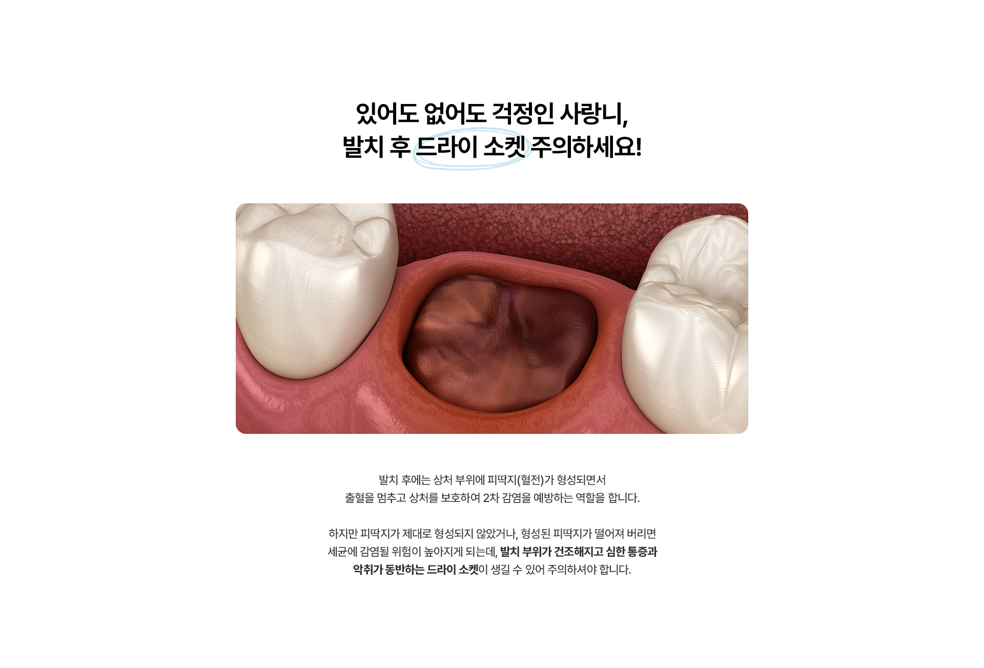 사랑니발치