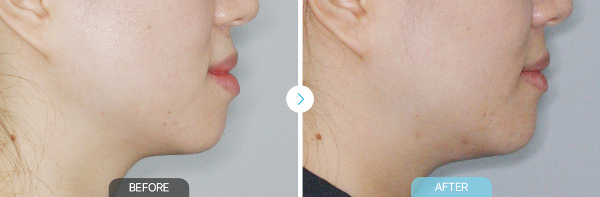 시술전후이미지